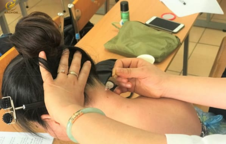 Cứu điều trị đau đầu, đau nửa đầu (Đầu thống)